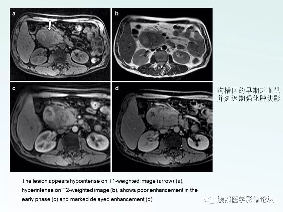 【PPT】沟槽性胰腺炎 【PPT】沟槽性胰腺炎