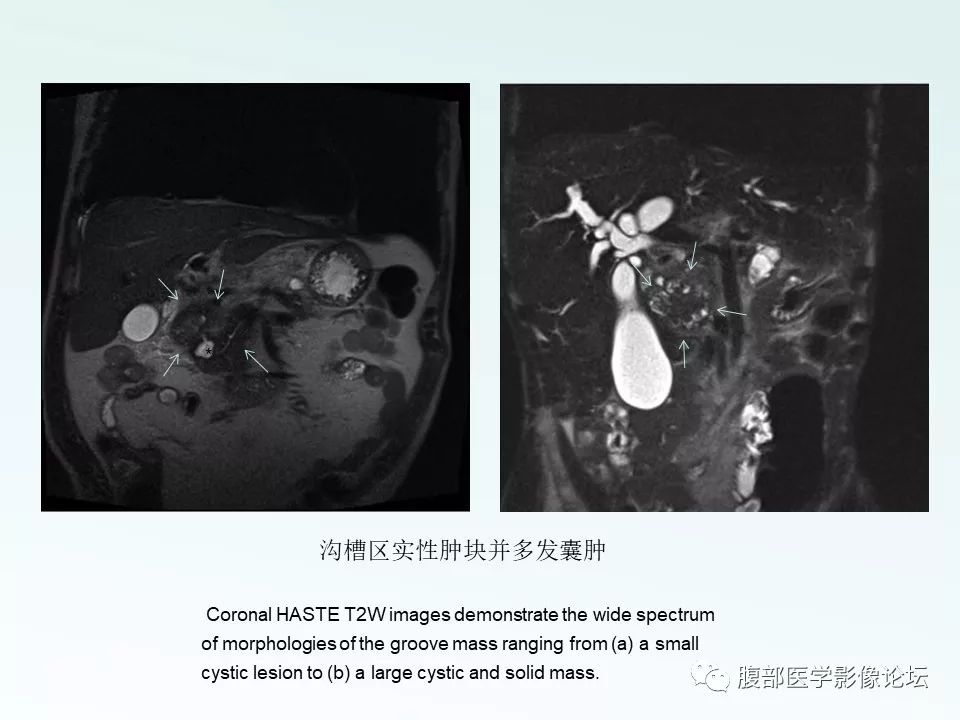 【PPT】沟槽性胰腺炎 【PPT】沟槽性胰腺炎