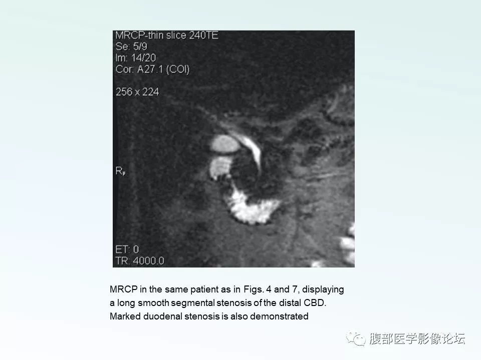 【PPT】沟槽性胰腺炎 【PPT】沟槽性胰腺炎