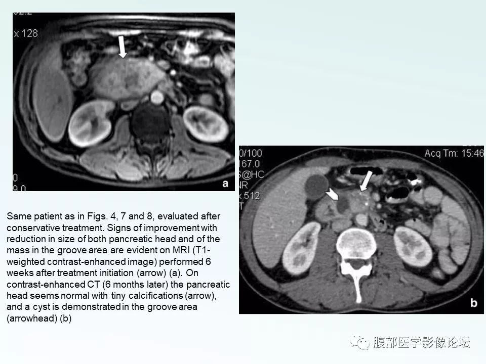 【PPT】沟槽性胰腺炎 【PPT】沟槽性胰腺炎