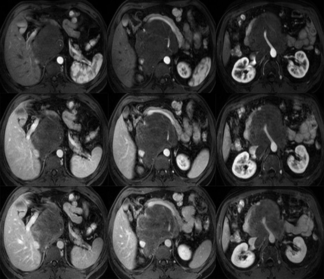 【病例】腹膜后占位1例—见缝就钻、包绕血管 【病例】腹膜后占位1例—见缝就钻、包绕血管
