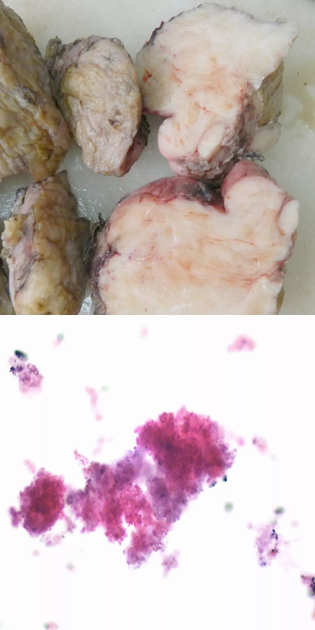 【病例】腹膜后占位1例—见缝就钻、包绕血管 【病例】腹膜后占位1例—见缝就钻、包绕血管