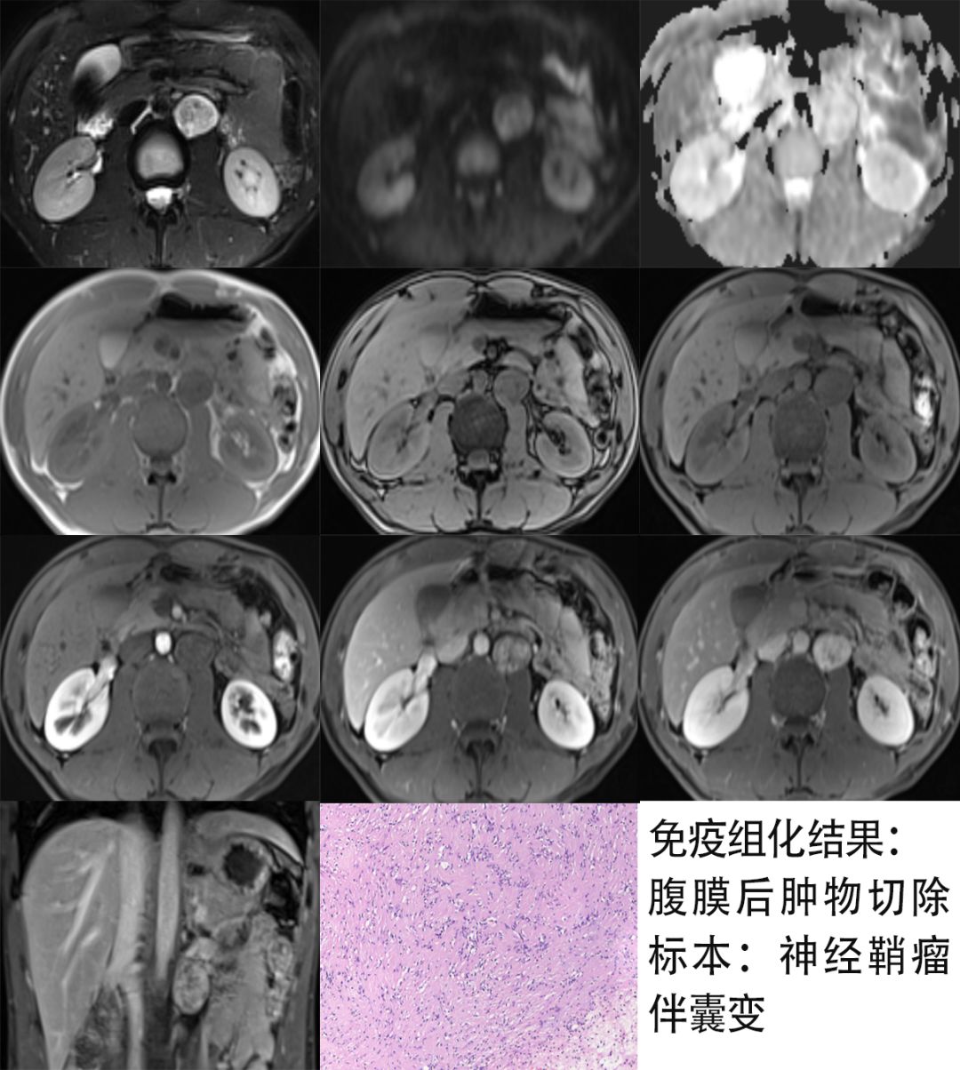 【病例】腹膜后占位1例—见缝就钻、包绕血管 【病例】腹膜后占位1例—见缝就钻、包绕血管
