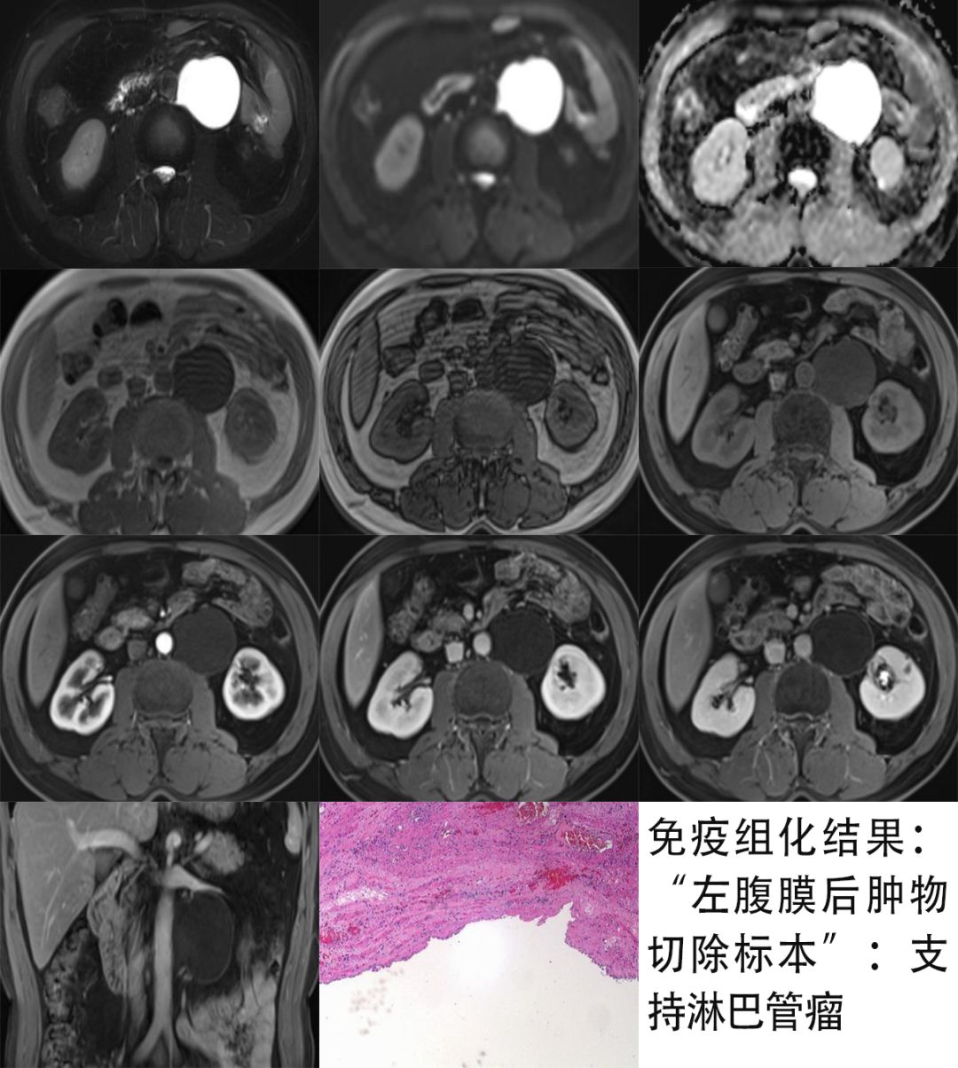 【病例】腹膜后占位1例—见缝就钻、包绕血管 【病例】腹膜后占位1例—见缝就钻、包绕血管