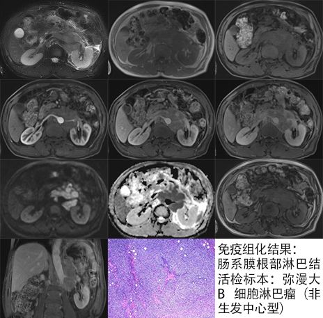 【病例】腹膜后占位1例—见缝就钻、包绕血管 【病例】腹膜后占位1例—见缝就钻、包绕血管