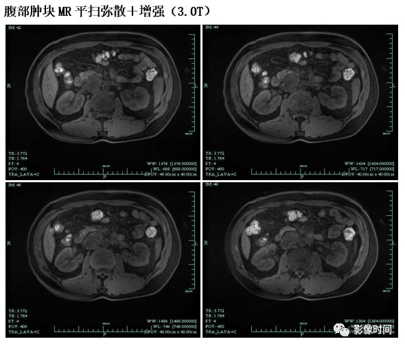 【病例】腹膜后占位1例—见缝就钻、包绕血管 【病例】腹膜后占位1例—见缝就钻、包绕血管
