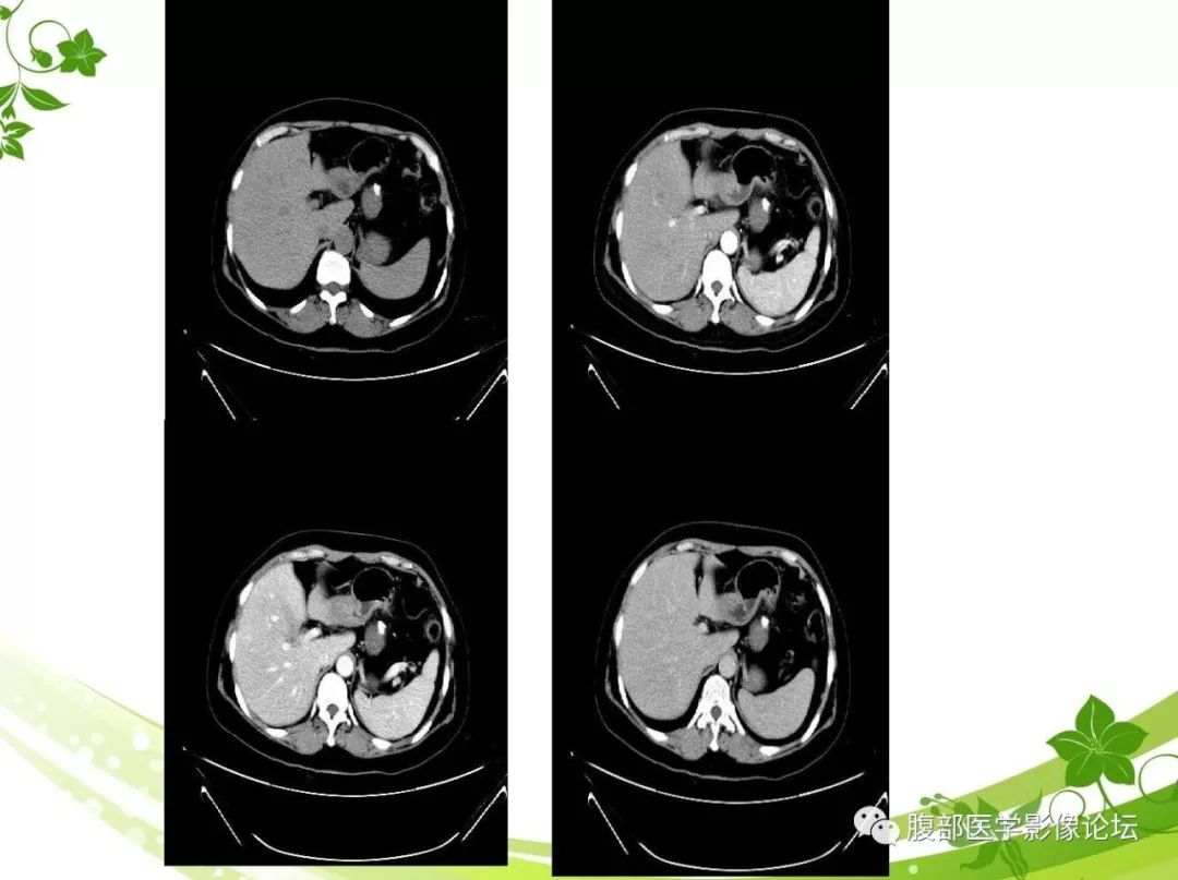【病例】胰腺实性假乳头状瘤1例CT及MR影像