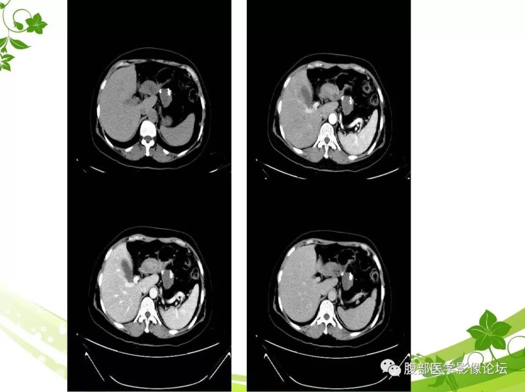 【病例】胰腺实性假乳头状瘤1例CT及MR影像