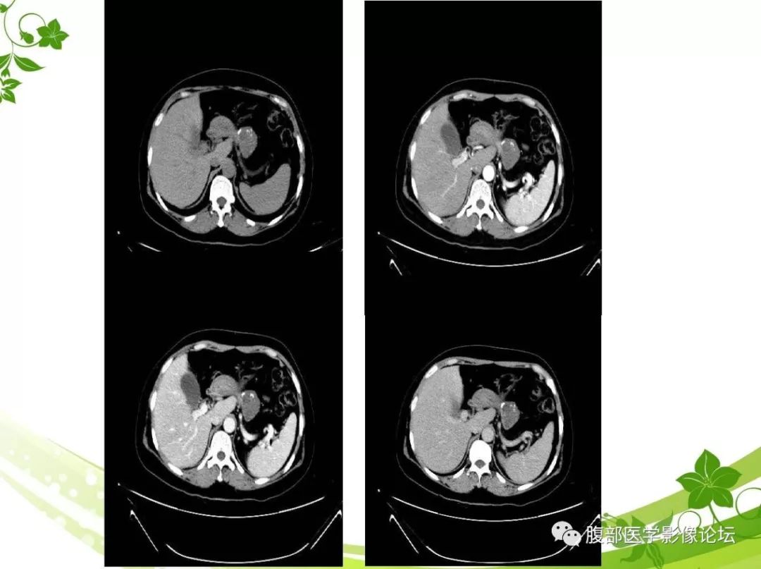 【病例】胰腺实性假乳头状瘤1例CT及MR影像