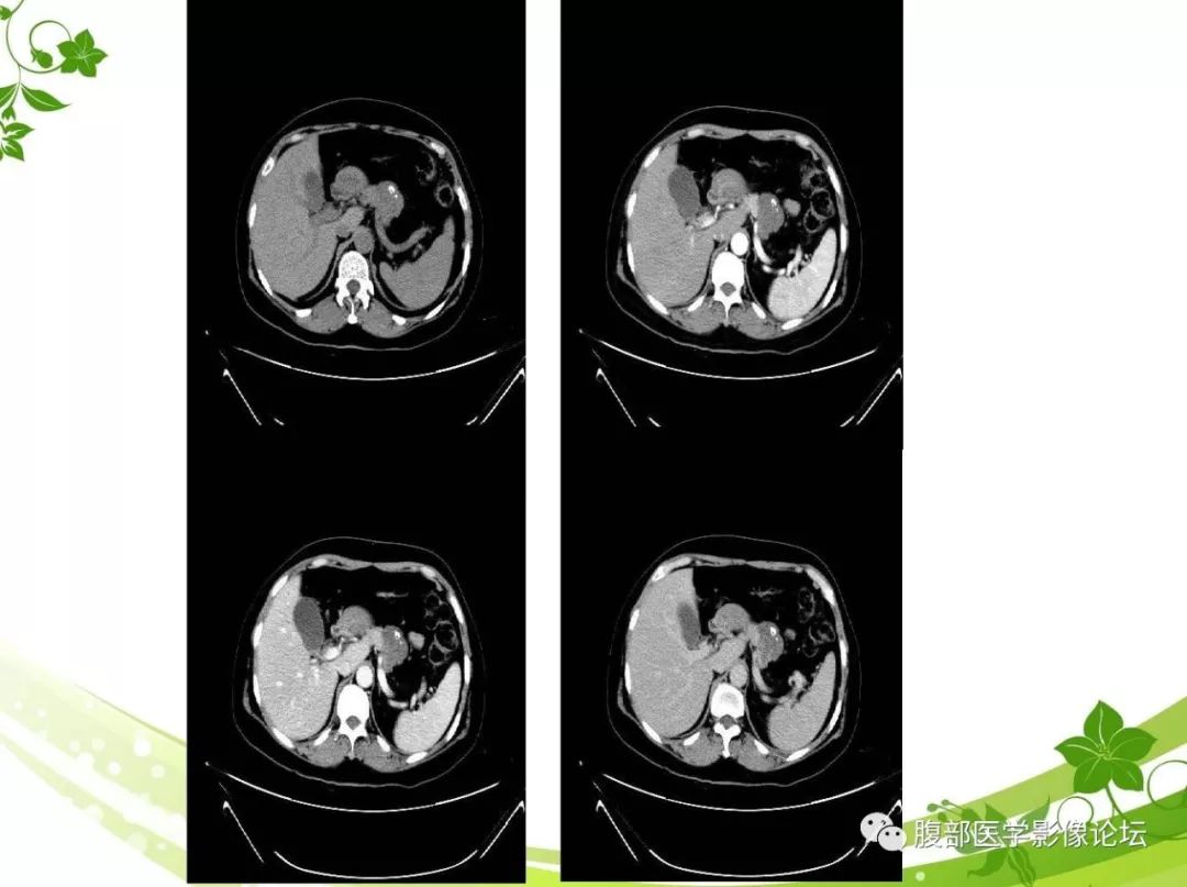 【病例】胰腺实性假乳头状瘤1例CT及MR影像