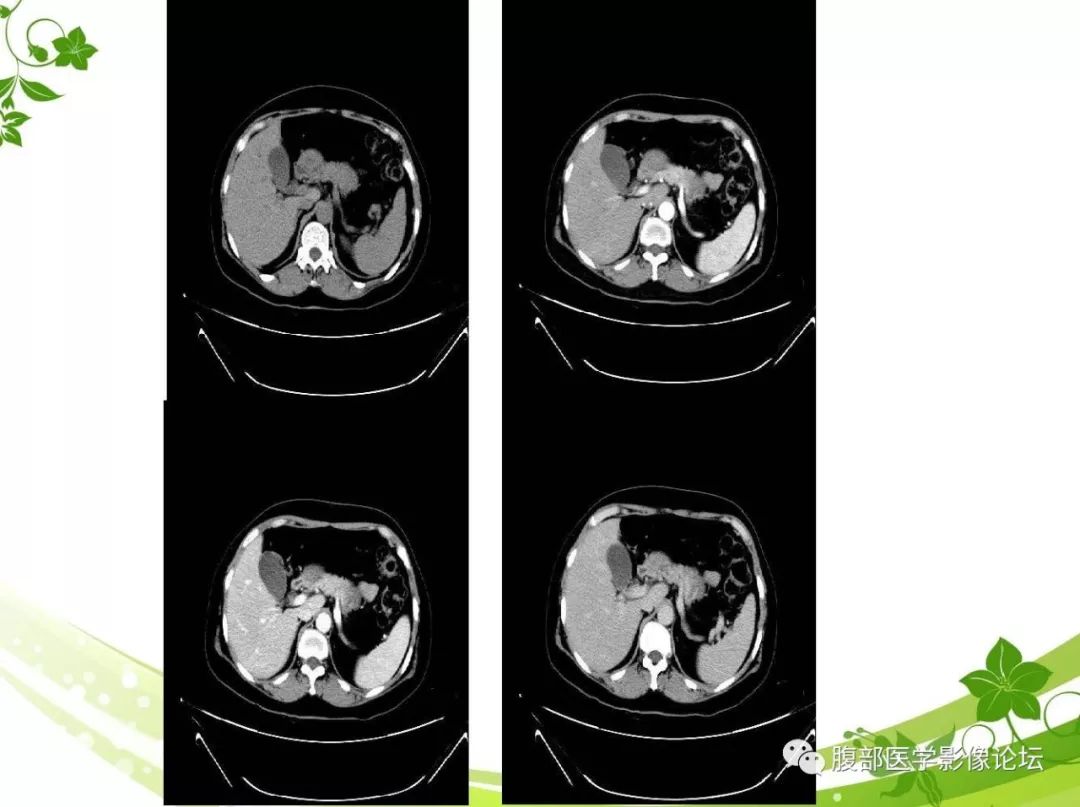【病例】胰腺实性假乳头状瘤1例CT及MR影像