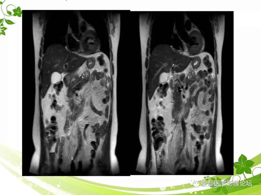【病例】胰腺实性假乳头状瘤1例CT及MR影像