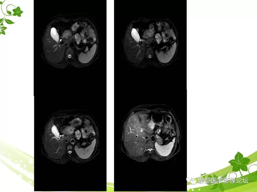 【病例】胰腺实性假乳头状瘤1例CT及MR影像