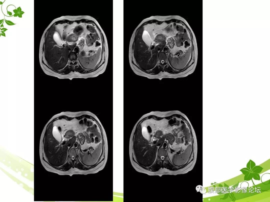 【病例】胰腺实性假乳头状瘤1例CT及MR影像