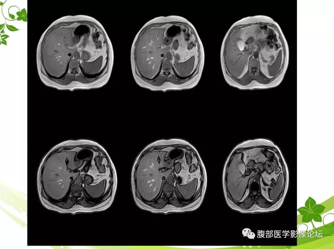 【病例】胰腺实性假乳头状瘤1例CT及MR影像