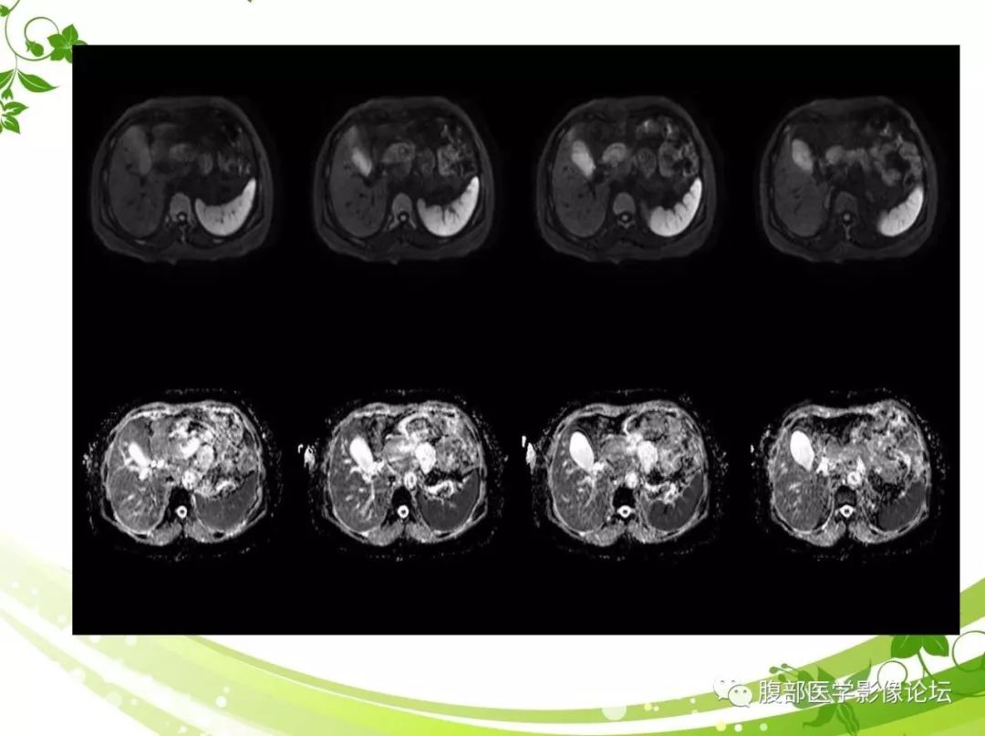 【病例】胰腺实性假乳头状瘤1例CT及MR影像
