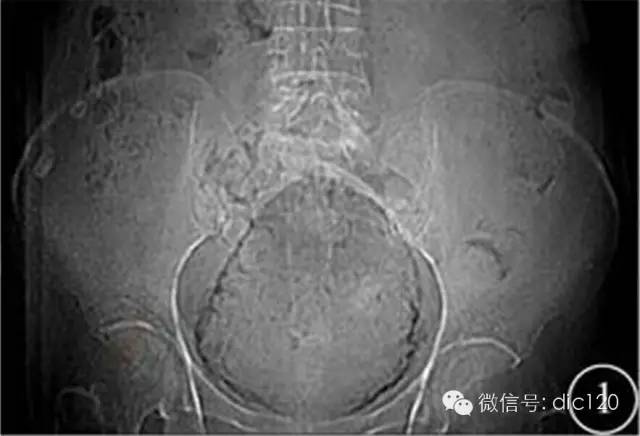 【病例】气肿性膀胱炎1例X线及CT影像