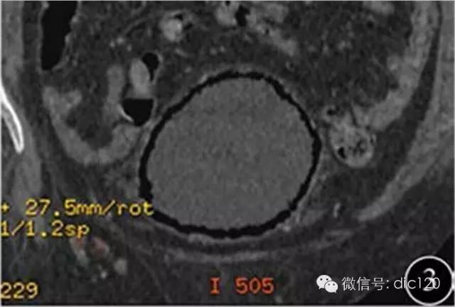 【病例】气肿性膀胱炎1例X线及CT影像 【病例】气肿性膀胱炎1例X线及CT影像