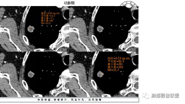 【病例】凶相毕露的肺结节1例CT影像讨论 【病例】凶相毕露的肺结节1例CT影像讨论
