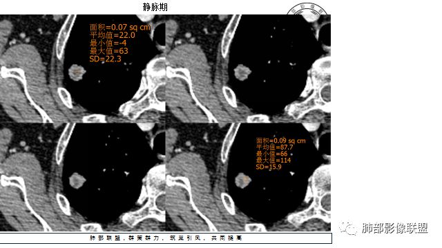 【病例】凶相毕露的肺结节1例CT影像讨论 【病例】凶相毕露的肺结节1例CT影像讨论