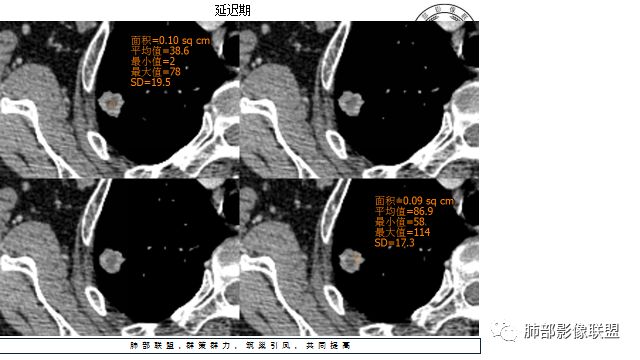 【病例】凶相毕露的肺结节1例CT影像讨论 【病例】凶相毕露的肺结节1例CT影像讨论