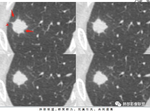 【病例】凶相毕露的肺结节1例CT影像讨论