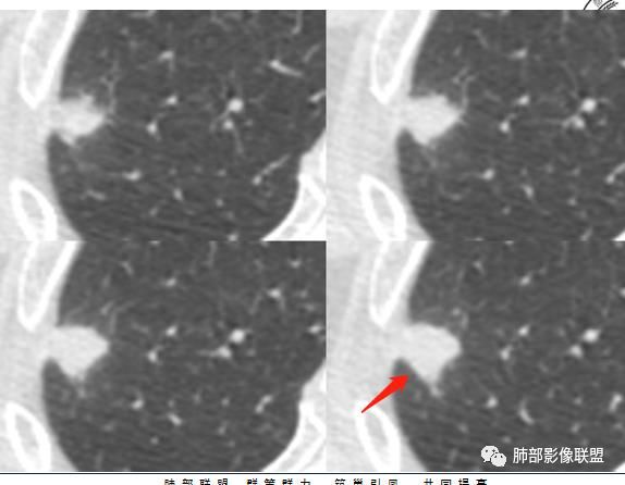 【病例】凶相毕露的肺结节1例CT影像讨论 【病例】凶相毕露的肺结节1例CT影像讨论