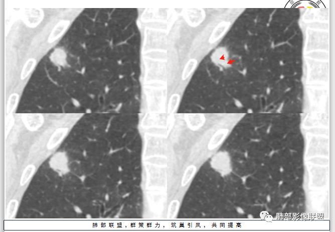 【病例】凶相毕露的肺结节1例CT影像讨论 【病例】凶相毕露的肺结节1例CT影像讨论