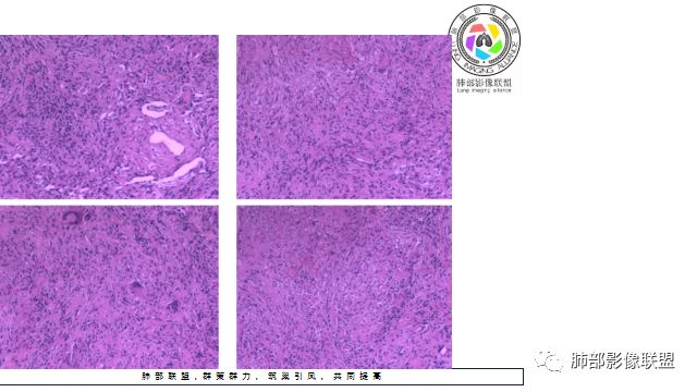 【病例】凶相毕露的肺结节1例CT影像讨论 【病例】凶相毕露的肺结节1例CT影像讨论