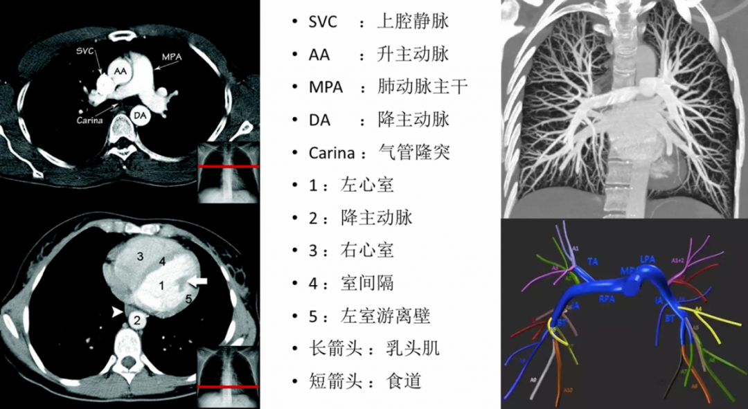 肺栓塞 CT 不会读?看完这篇文章轻松入门! 肺栓塞 CT 不会读?看完这篇文章轻松入门!