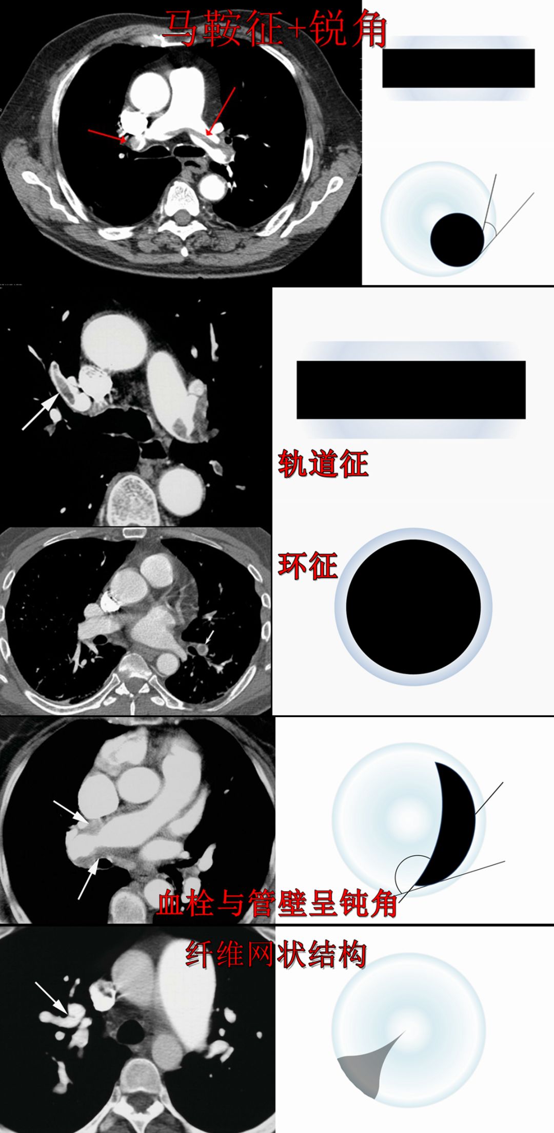 肺栓塞 CT 不会读?看完这篇文章轻松入门! 肺栓塞 CT 不会读?看完这篇文章轻松入门!