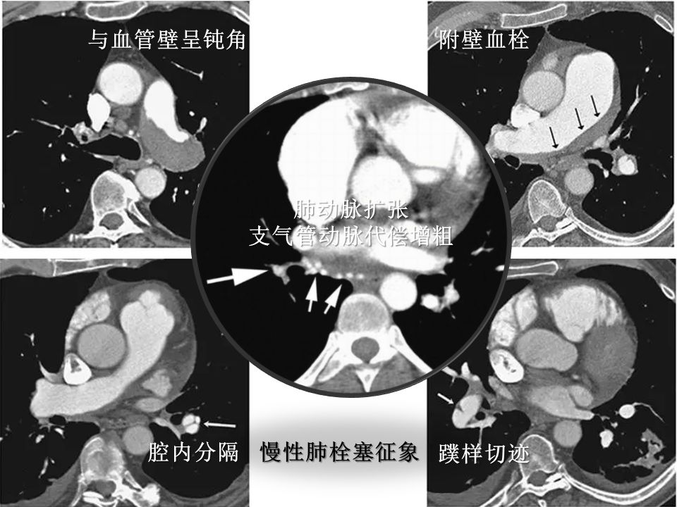 肺栓塞 CT 不会读？看完这篇文章轻松入门！