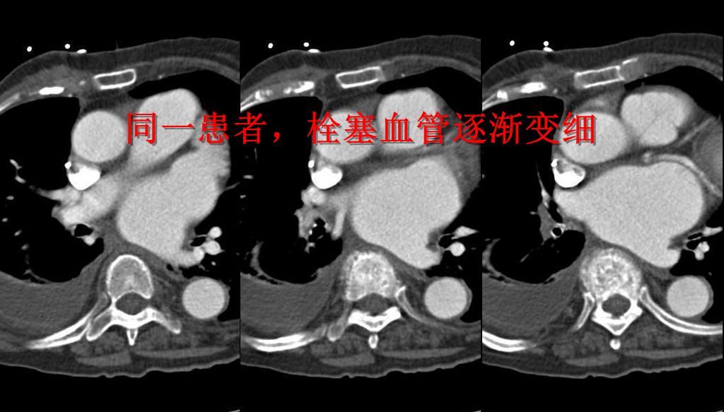 肺栓塞 CT 不会读?看完这篇文章轻松入门! 肺栓塞 CT 不会读?看完这篇文章轻松入门!
