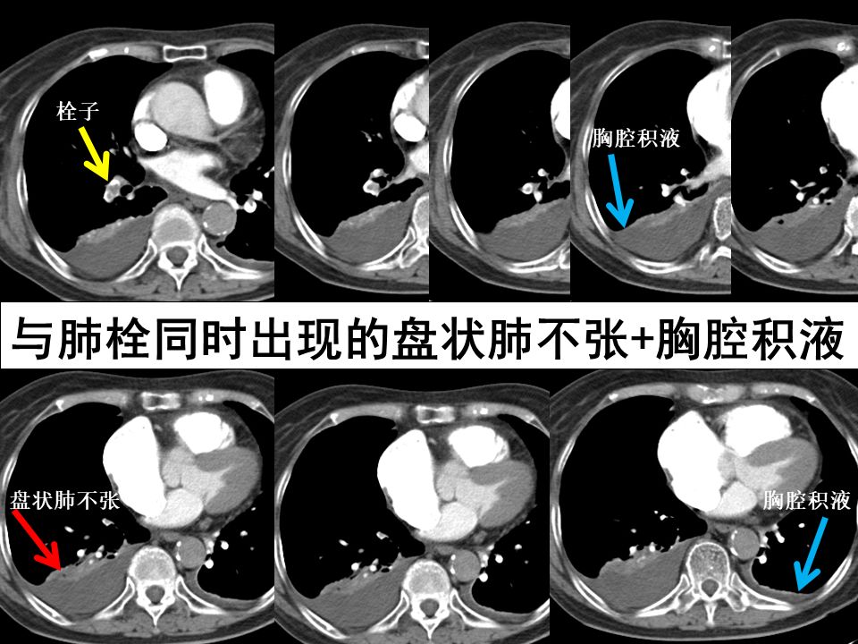 肺栓塞 CT 不会读?看完这篇文章轻松入门! 肺栓塞 CT 不会读?看完这篇文章轻松入门!