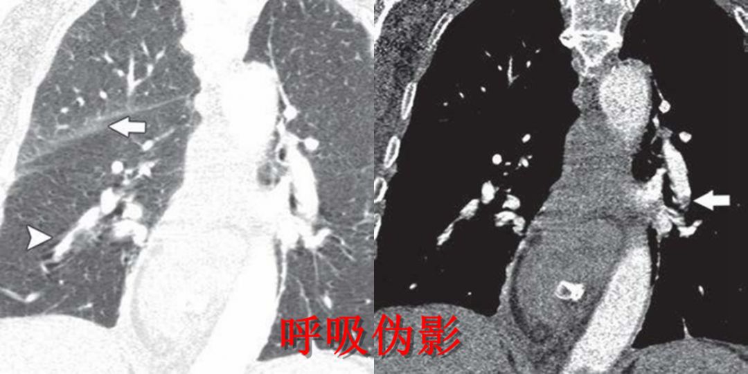 肺栓塞 CT 不会读?看完这篇文章轻松入门! 肺栓塞 CT 不会读?看完这篇文章轻松入门!