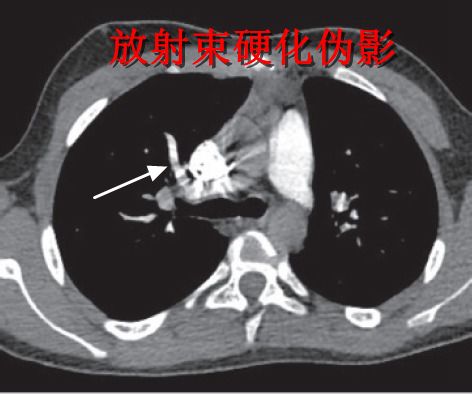 肺栓塞 CT 不会读?看完这篇文章轻松入门! 肺栓塞 CT 不会读?看完这篇文章轻松入门!