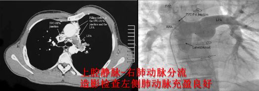 肺栓塞 CT 不会读?看完这篇文章轻松入门! 肺栓塞 CT 不会读?看完这篇文章轻松入门!