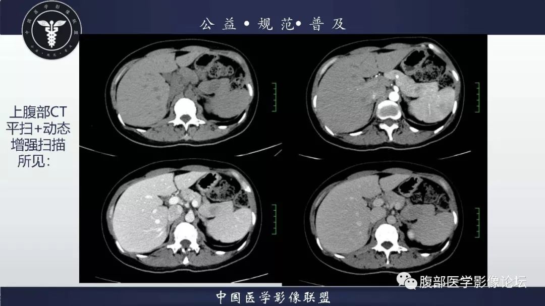 【病例】胰体尾实性假乳头状肿瘤1例CT及MR影像