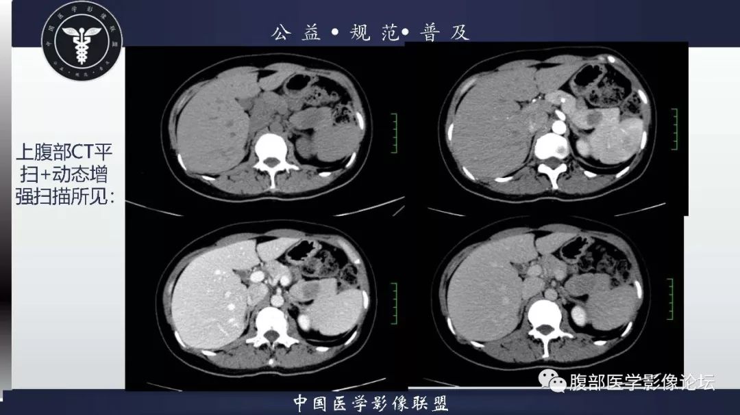 【病例】胰体尾实性假乳头状肿瘤1例CT及MR影像