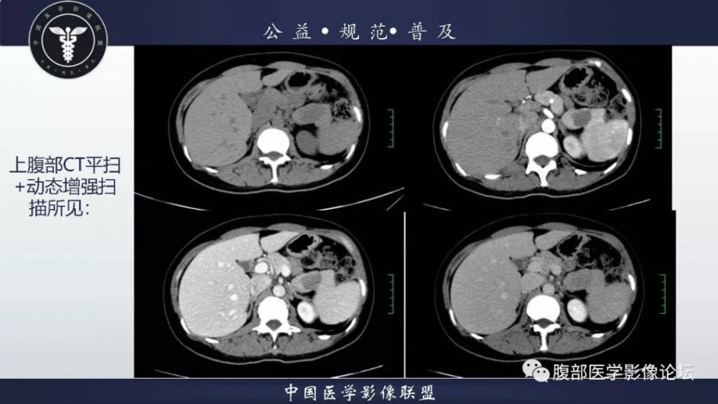 【病例】胰体尾实性假乳头状肿瘤1例CT及MR影像