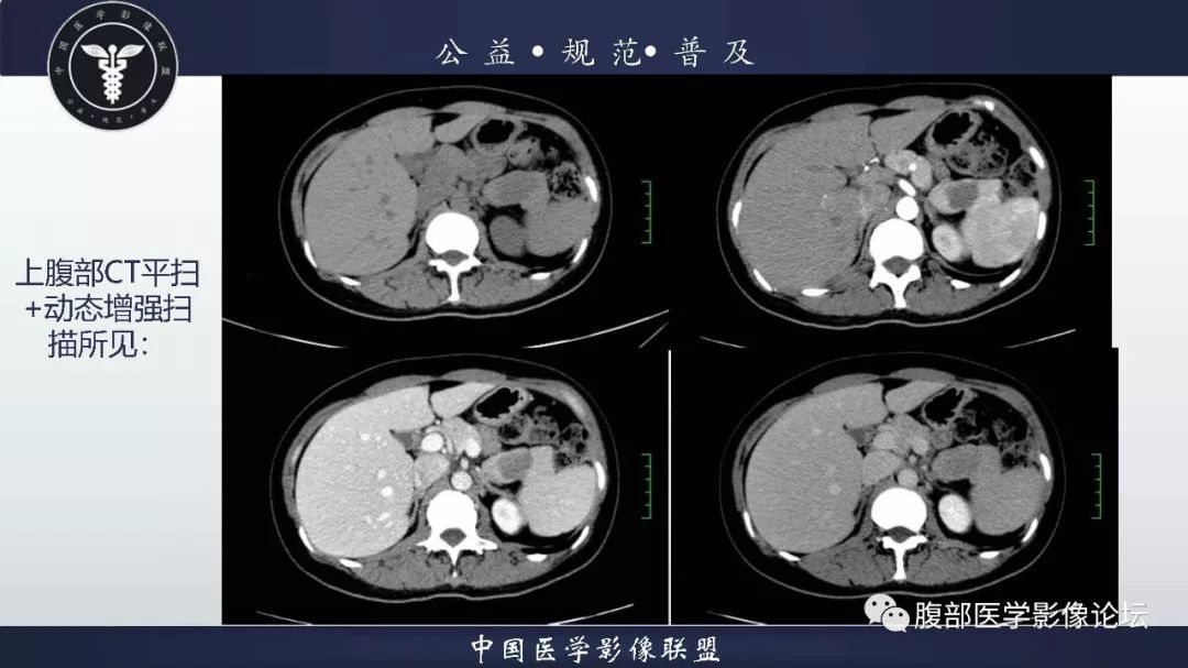 【病例】胰体尾实性假乳头状肿瘤1例CT及MR影像