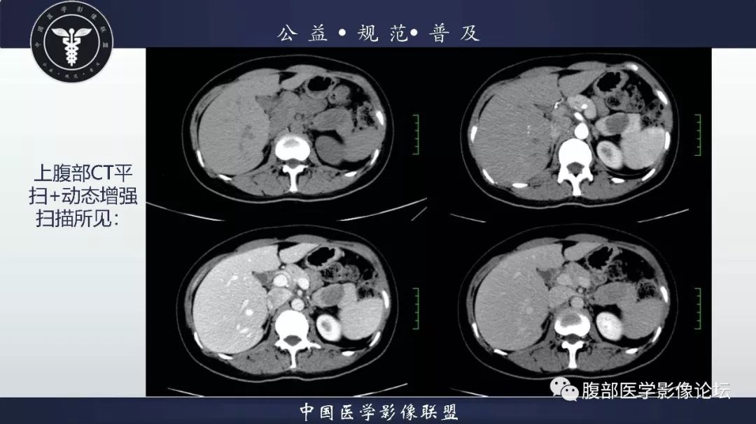 【病例】胰体尾实性假乳头状肿瘤1例CT及MR影像