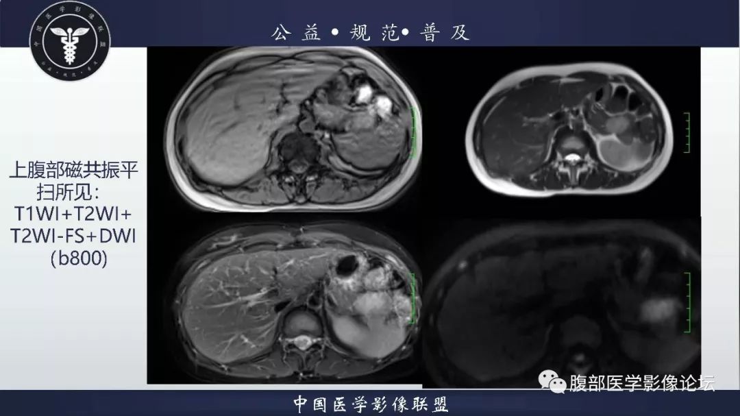 【病例】胰体尾实性假乳头状肿瘤1例CT及MR影像