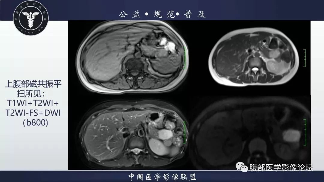 【病例】胰体尾实性假乳头状肿瘤1例CT及MR影像