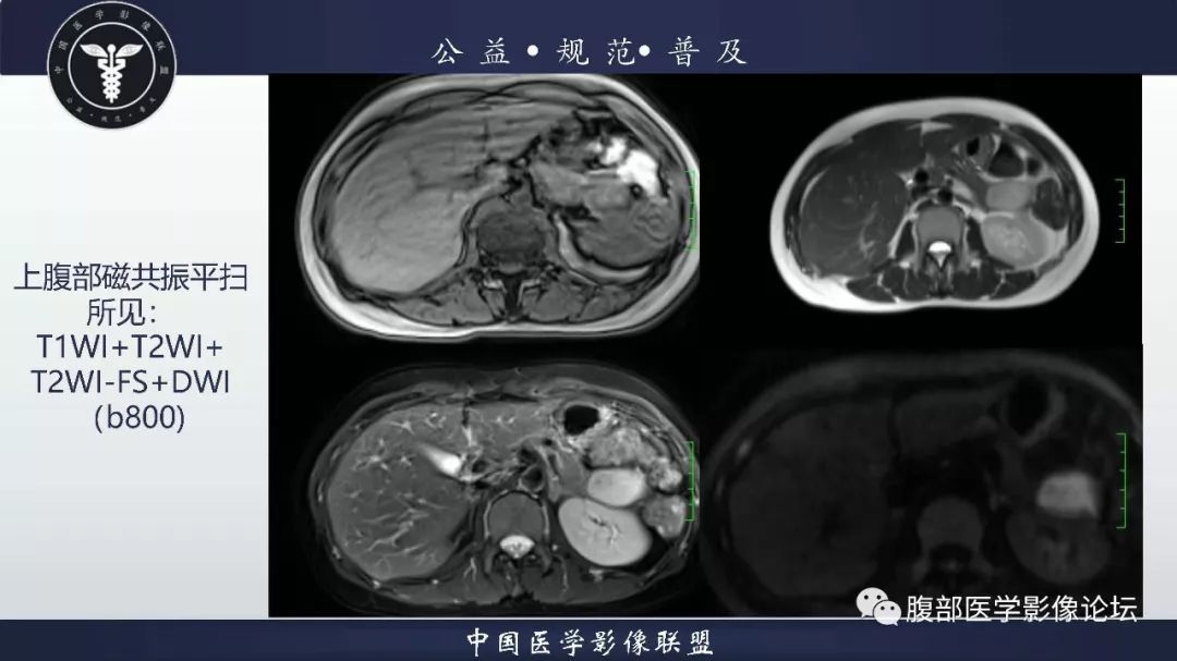 【病例】胰体尾实性假乳头状肿瘤1例CT及MR影像