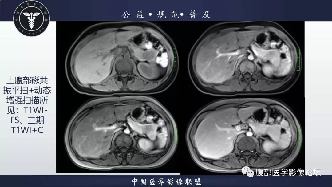 【病例】胰体尾实性假乳头状肿瘤1例CT及MR影像