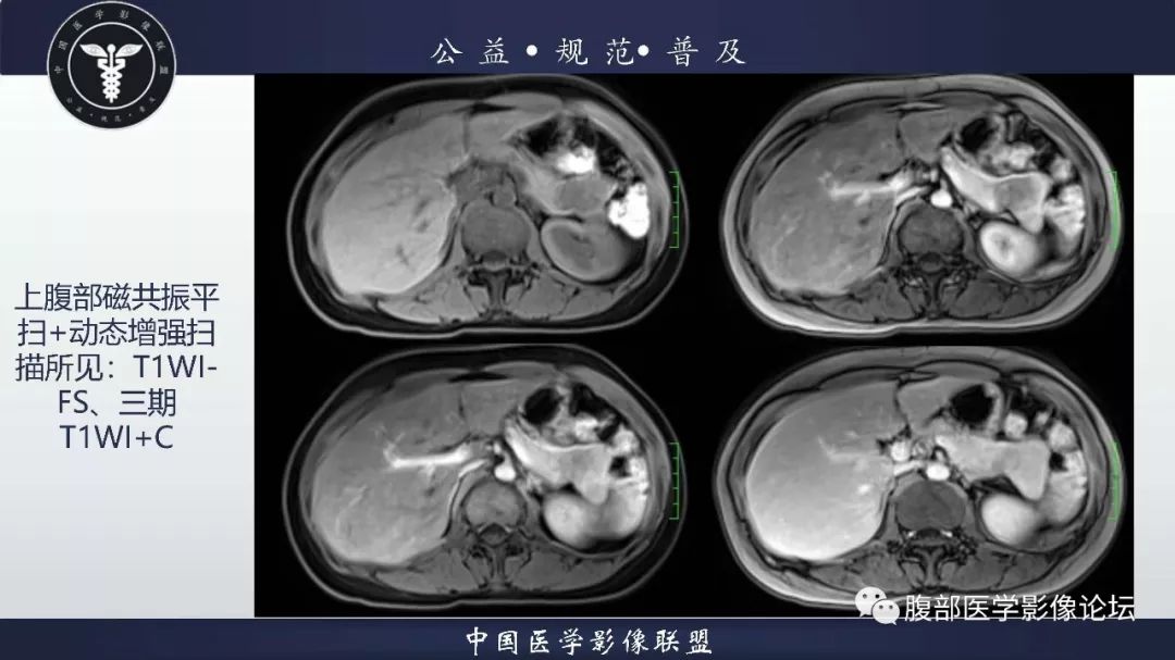 【病例】胰体尾实性假乳头状肿瘤1例CT及MR影像