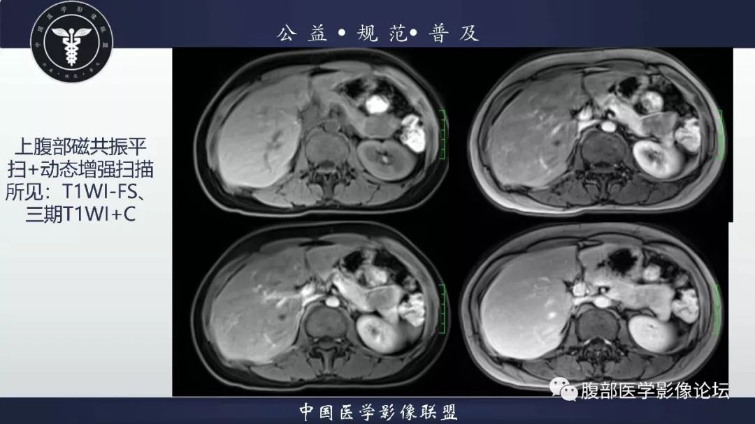 【病例】胰体尾实性假乳头状肿瘤1例CT及MR影像
