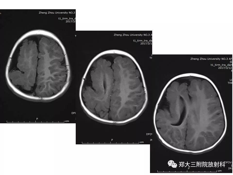 【病例】脑裂畸形3例MR影像解读