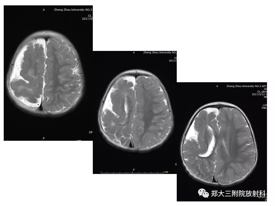 【病例】脑裂畸形3例MR影像解读